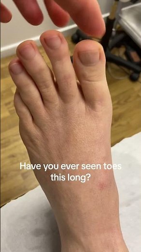 Unbelievably Long Toes: A Fascinating Foot Phenomenon #IncredibleFeet #MustSee