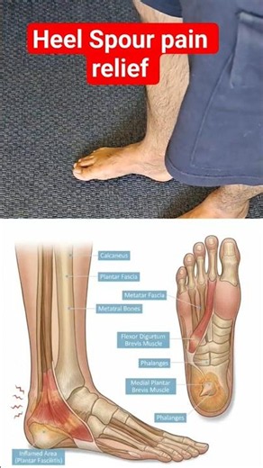 Heel spur pain relief At home To walk properly must continue this 3 steps 5 days a week!!
