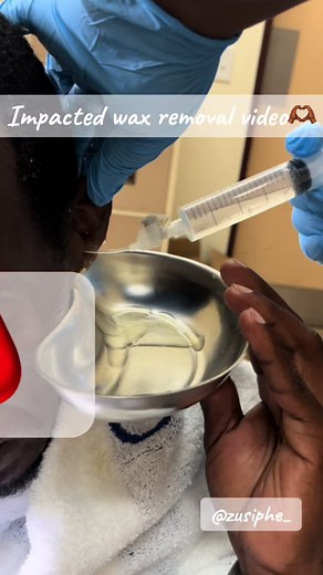 Impacted wax removal video 🙏🏾 #SAMA28 #trendingvideo #fyp #satisfyingvideo #earwax #audiologist #audiologist