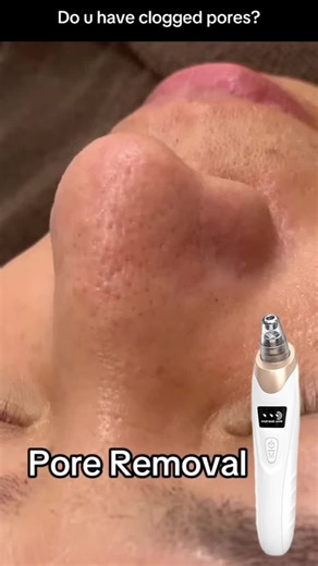 Pore vacuums help deeply cleanse the skin by removingblackheads | blackhead