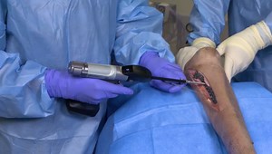 Proximal Medial Tibial Plating: Demonstrating the Value of Live Depth Measurement