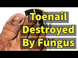 Toenail Destroyed By Fungus: Removal of Toenail Due To Fungal Infection