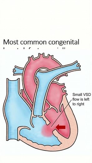 Three keypoints of ventricular septal defect