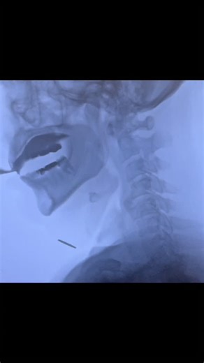 Jessica W. Gregor SLP, BCS-S | Fluoroscopy can identify all kinds of normal anatomic variants as well as more ominous ones… like cancer. Therefore, it is critical to have... | Instagram