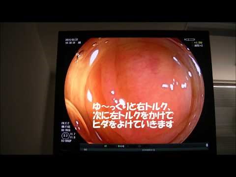 大腸内視鏡検査（通常例）