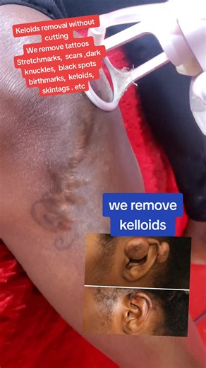 Keloids removal without cutting We remove tattoos Stretchmarks, scars ,dark knuckles, black spots birthmarks, keloids, skintags . etc #foryoupagе #goviralgoviralgo #trending #foryou #foryoupage❤️❤️