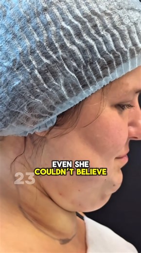 8.7K views · 32 reactions | She Got a Chin Reduction and Looks 20 Years Younger! The Transformation Is Unreal... Results in Comments!  | Life After 60 | Facebook