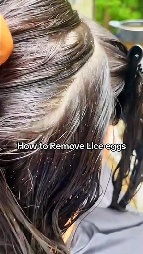 How to remove lice eggs #haircaretips #skincareroutine #beautytips #glowup girls ✨
