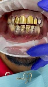Say goodbye to your gold veneers and embrace a smile makeover with porcelain design. 🔥🔥 | Dental Design Smile