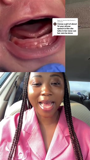 Understanding Speech Abnormalities Beyond Tongue Tie