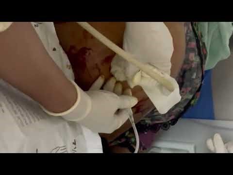 Amniocentesis Procedure Under Ultrasound Guidance | Radiology Tutorial