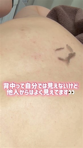 背中って意外と見られてるの知ってた？😳 後ろ姿もちゃんと整える時代✨#医療脱毛 #ジェントルマックスプロプラス #背中脱毛 #レナトゥスクリニック