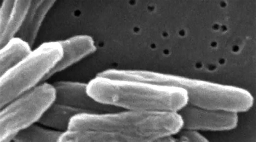 Lubbock health professionals explain what you need to know about Tuberculosis