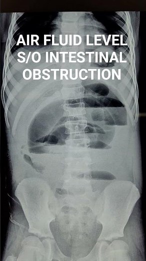 AIR FLUID LEVELS ON X RAY ABDOMEN ERECT S/O INTESTINAL OBSTRUCTION