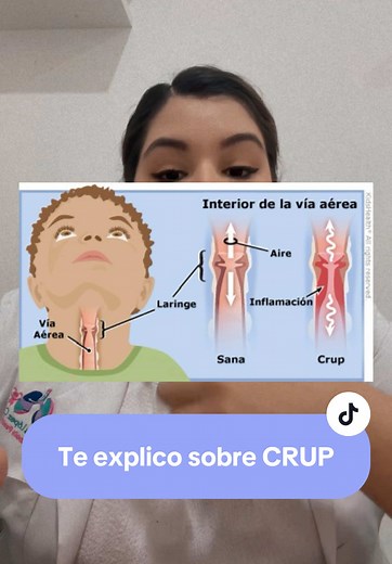 Entendiendo el CRUP en Pediatría