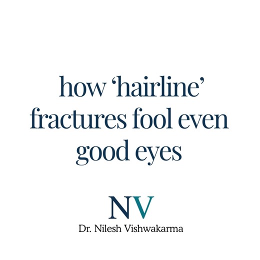 Nilesh Vishwakarma on Instagram: "Hairline (stress or occult) fractures are some of the most frequently missed injuries on initial X-rays — not because of poor skill, but because these cracks are genuinely difficult to see. They often blend with normal trabecular patterns, hide along the cortex, and may not produce any visible step-off or periosteal reaction in the first few days. That’s why a patient may walk in with a “normal” X-ray but pain that is out of proportion to the mechanism of injury