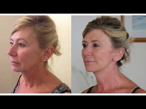High SMAS facelift Before and After| Patient Review | Mr Vasu Karri