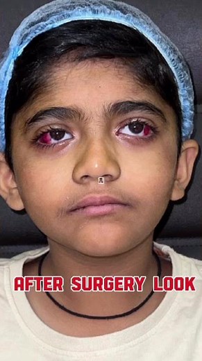 Alternate Exotropia Squint Surgery (Bilateral Lateral Rectus Recession) | Pediatric Eye – Ankit Shah