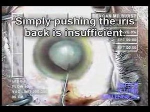 Iris Prolapse During Cataract Surgery - Proceeding • Video • MEDtube.net