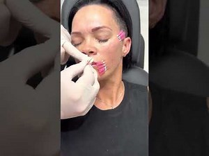 PDO threads in the lower face | Accordion lines cosmetic treatment | Newcastle Cosmetic Doctor