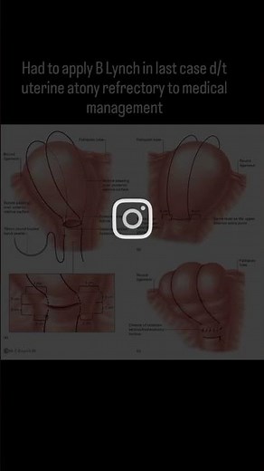 B‑Lynch suture #drfarwa #obgyn