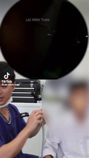 🚨Warning : Extremely satisfying ear wax extraction ahead 🙃😩✨.Watch this monster wax plug come out!! Now, those ears can breathe again. 🧘 🤯😤