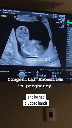 12 Weeks Baby Congenital Defect