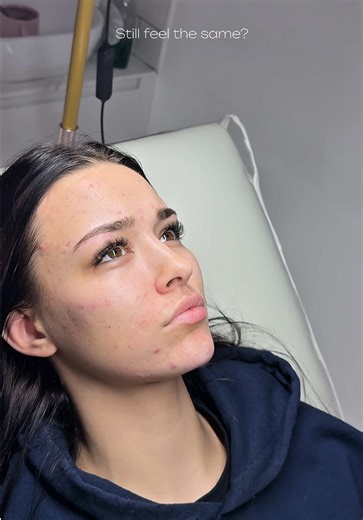 3ml did ALL of this… 👀✨ Strategic chin & cheek contouring to lift, balance and sculpt the face. without looking filled or fake. No overdone volume. No pillow face. Just structure, definition & harmony. This is your sign you don’t always need loads of filler. You just need correct placement 🤍 Would you try subtle contouring? DM us SCULPT if this is your vibe🩷 #bristolAesthetics #bristolFacialContouring #ChinFiller #CheekFiller #viral