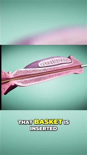 Prostate Treatment Revolutionary ITIND Procedure