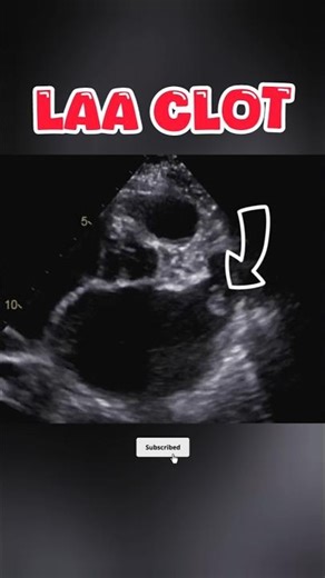 Clot in Left Atrial Appendage #echocardiography #heart #cardiology