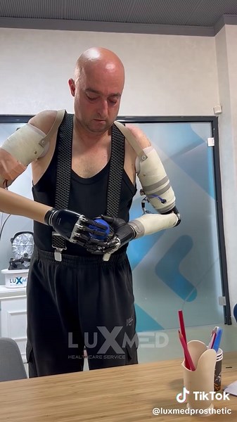 Above-Elbow Arm Prosthesis: Life-Changing Technology!Above-Elbow Arm Prosthesis: Life-Changing Technology! #prostheticarm #protezkol #prosthesis