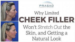 How to get Natural Results with Cheek Fillers