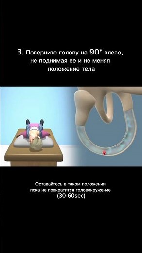 Маневр Эпли. Перекатка аталитового камушка в полукружном канальце