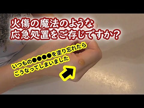やけどの応急処置には●●●●が効くってご存じですか？【火傷対処法】