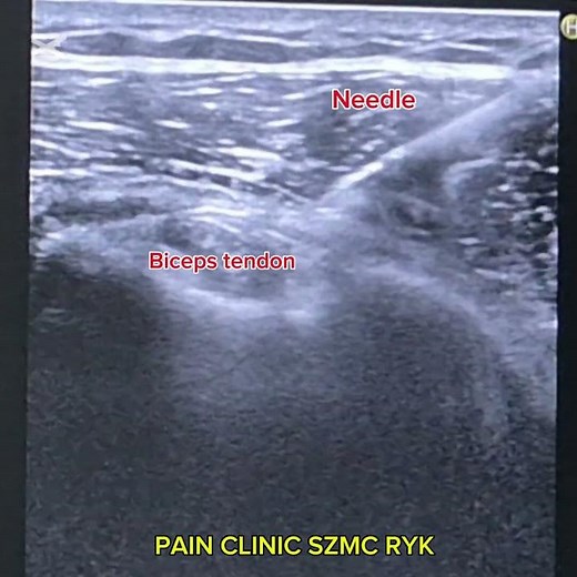 Bicipital tendon sheath steroid injection by Dr Sairah at Pain clinic SZMC RYK.