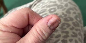 Brown line on mom’s fingernail turns out to be rare form of melanoma