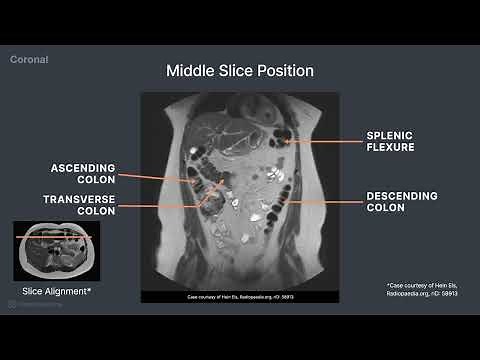 MRI Cross Sectional Anatomy of the Abdomen (Coronal View)