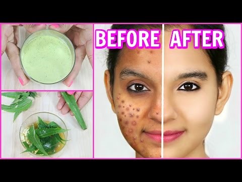 Remove Pimples Permanently (100% Results) - DIY Face Wash, Spot Treatment | Anaysa