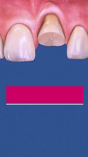 Broken Tooth Reconstruction #dentalwork #brokentooth #fixingbrokentooth