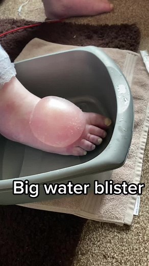 Understanding Water Blisters: Causes and Removal Tips