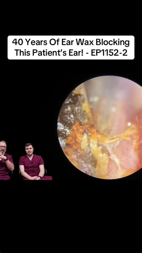 40 Years Of Ear Wax Blocking This Patient’s Ear! - EP1152-2 | clogged ear wax removal