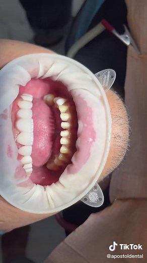 Full Mouth Restoration with Zirconia Fixed Bridge and Veneers