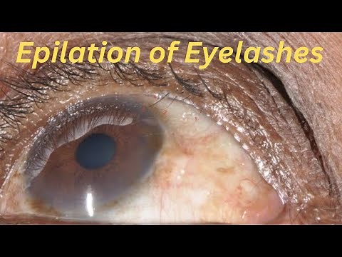 Epilation of eye | trichiasis | eyelash removal from eye | ingrown lashe | inturned eyelash
