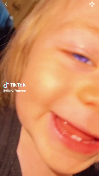 Understanding Purple Eyes in Albino Babies