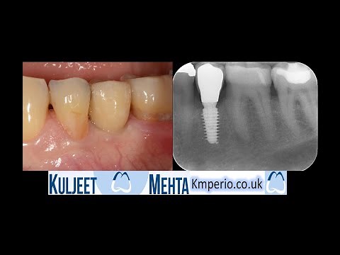 Extraction & Implant placement with PRF