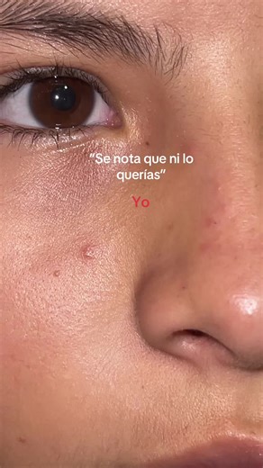 Se re nota #querer #granitos #insistir? #alegia 😅😔 | acne facial