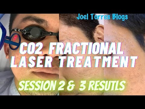 My 2nd and 3rd Sessions Before Results Co2 Fractional Laser Acne Scar Treatment in Cebu Philippines