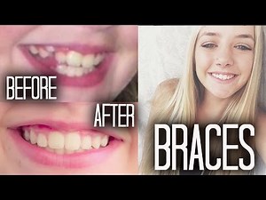 Braces 101 + Before & After!