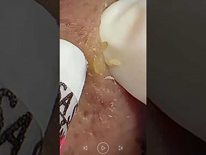 Acne Treatment & Blackhead Removal | Very Satisfying Pimple Popping #345