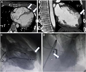 Direct ablation and excision of myocardial scar in post-myocarditis ventricular aneurysm